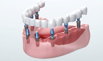 Affordable Dental Implants