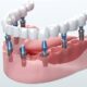 Affordable Dental Implants