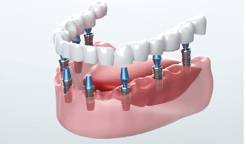 Affordable Dental Implants